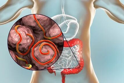 Parassiti nell'intestino